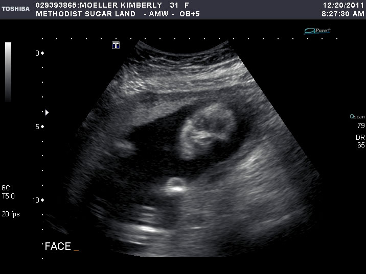 ultra sound image two